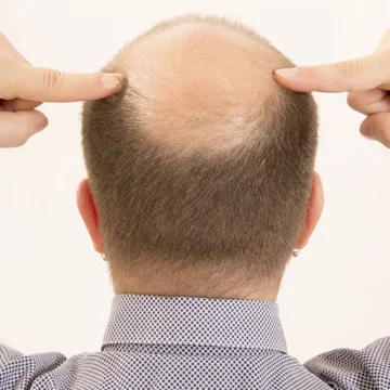 imagen_2026-06-11_182243296 ¿Por qué se cae más el pelo en otoño? La ciencia detrás de la caída estacional y cuándo podría ser señal de una alopecia